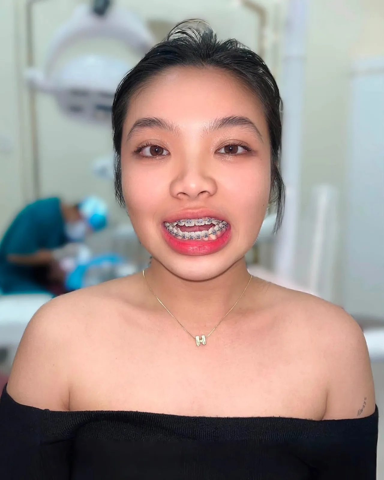 5 tháng niềng - Mai Anh