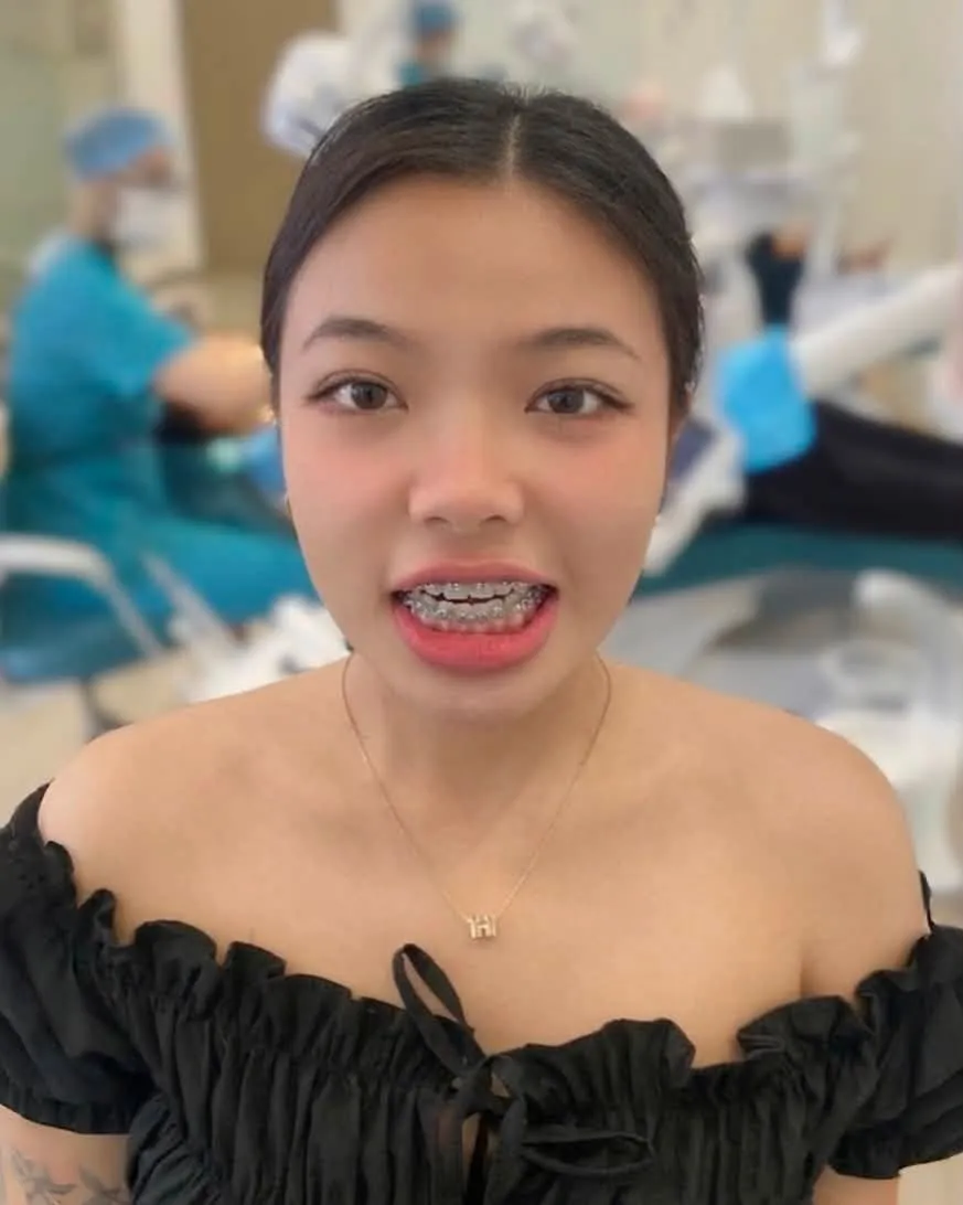9 tháng niềng - Mai Anh
