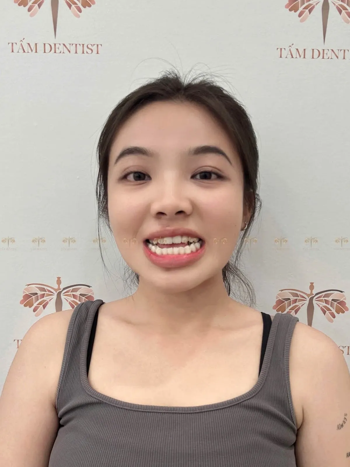 Chưa niềng - Mai Anh