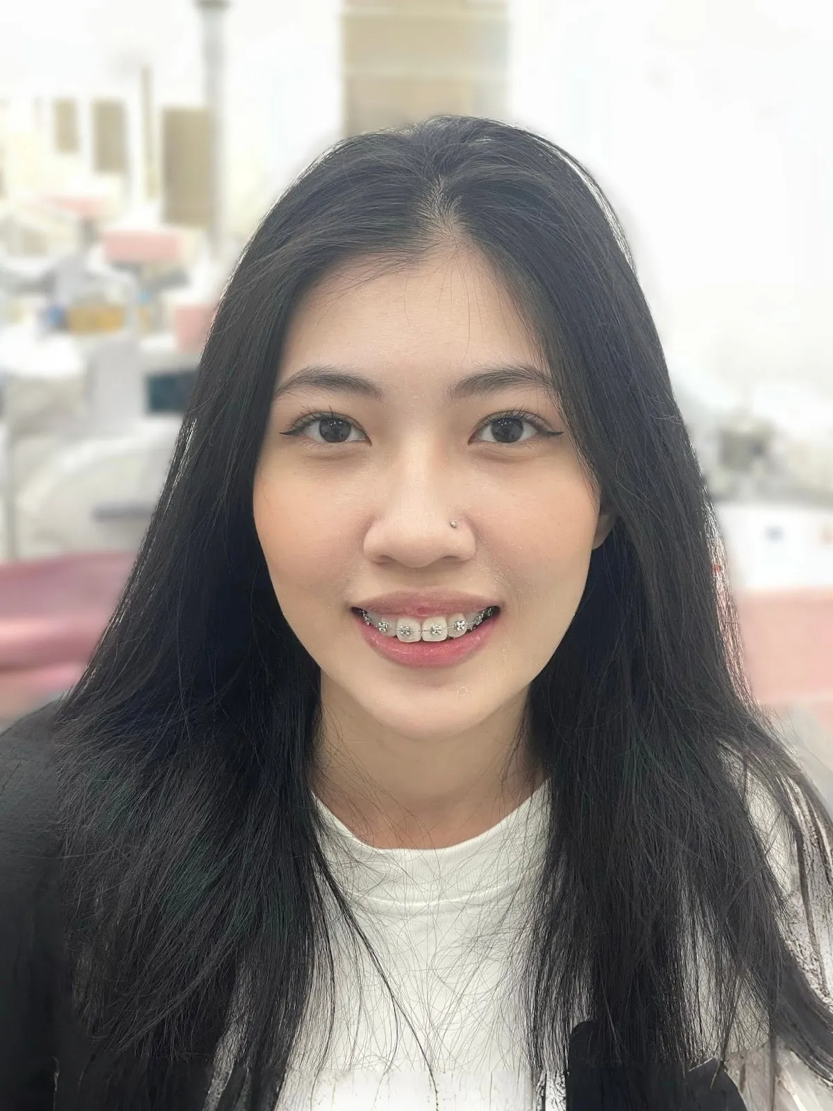 8 tháng niềng - Ngọc Trâm