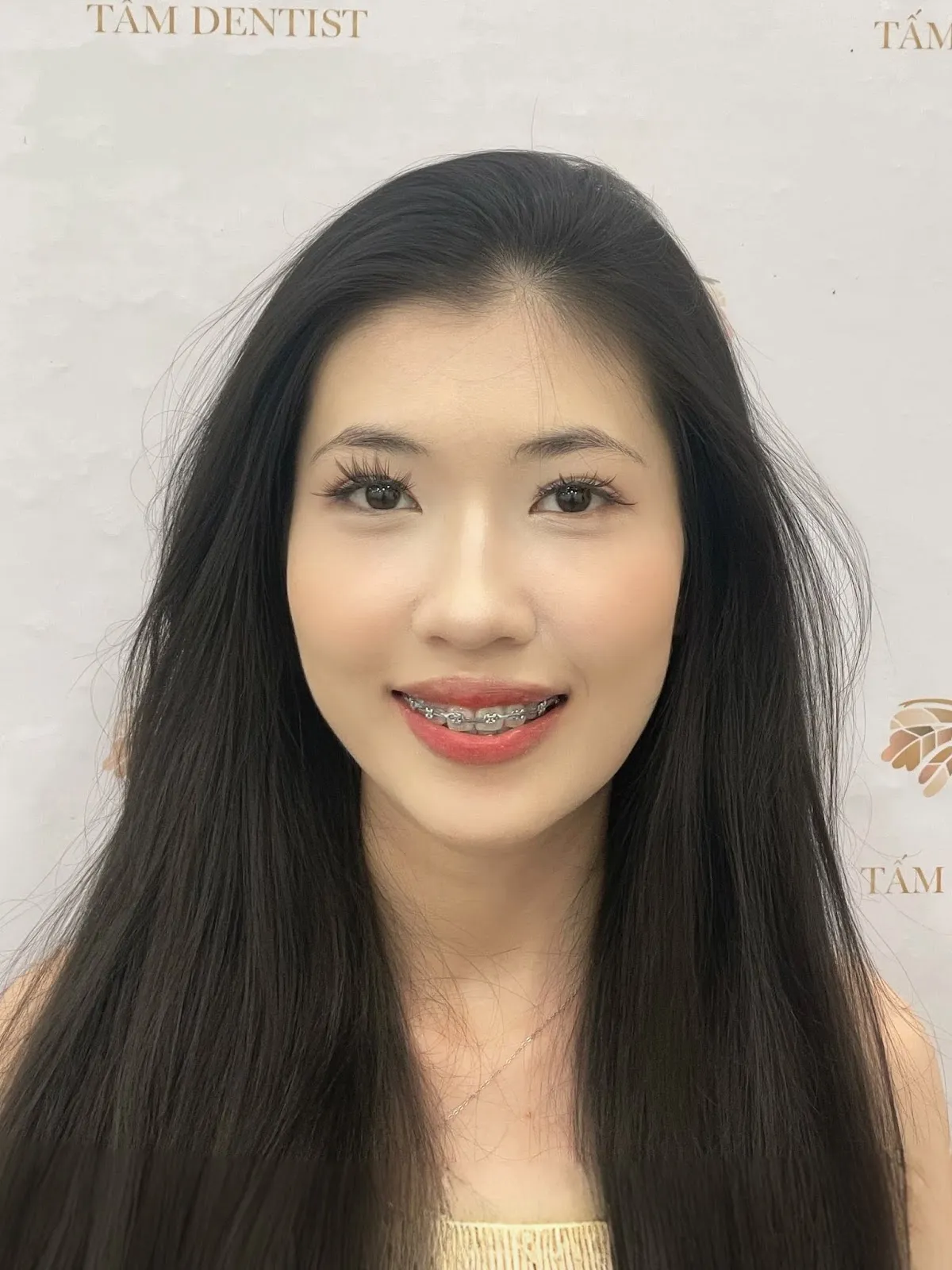 Kết quả niềng răng của Ngọc Trâm