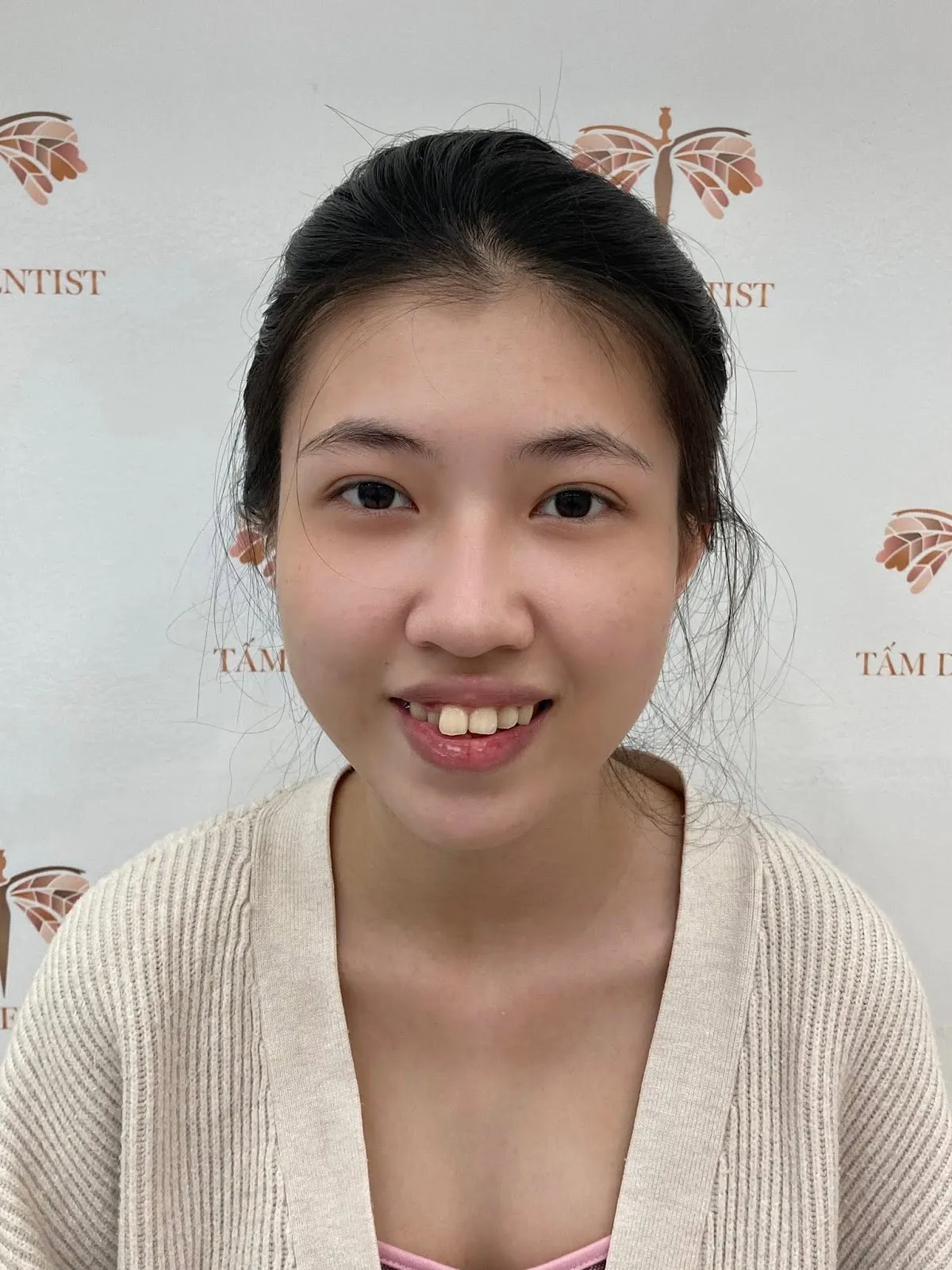 Trước niềng - Ngọc Trâm