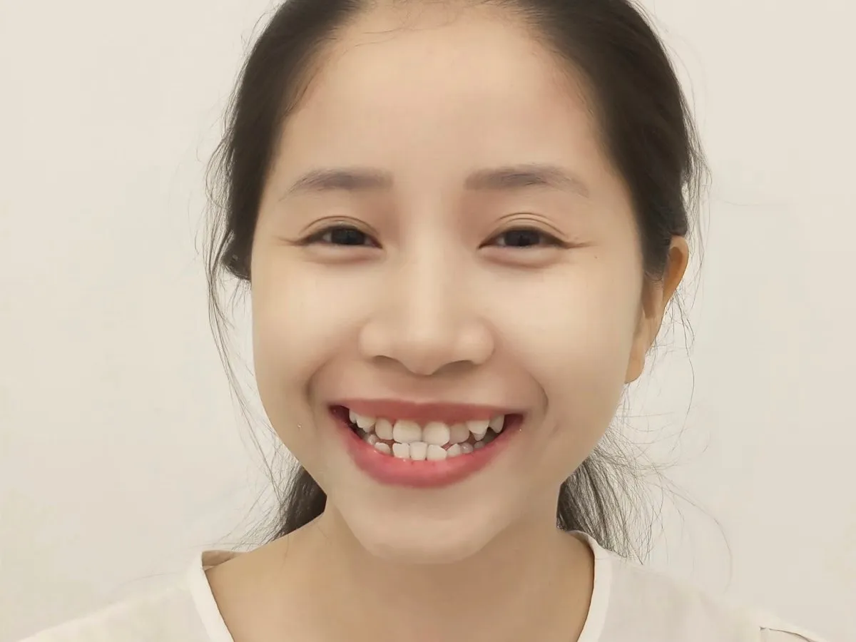 Chị Thanh Trâm (30 tuổi, TP.HCM) – Trước Niềng