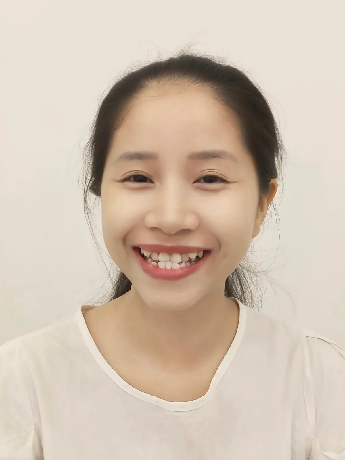 Trước Khi Niềng Răng - Thanh Trâm