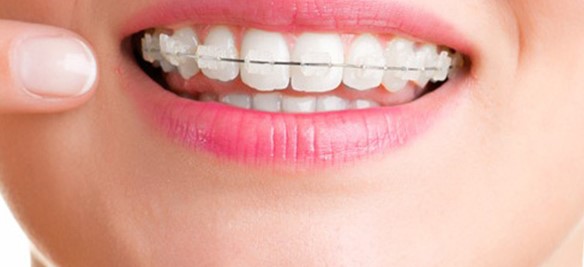 Một số tác hại của niềng răng