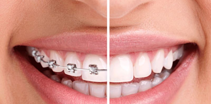 trước và sau khi niềng răng