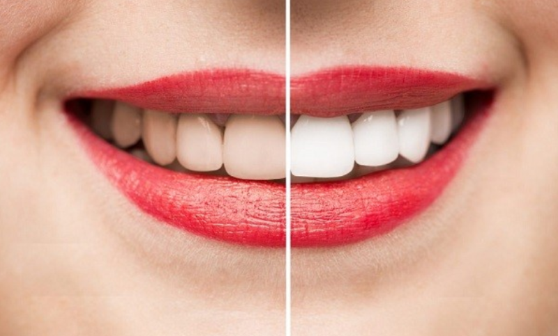 Tẩy trắng răng có làm yếu răng không?