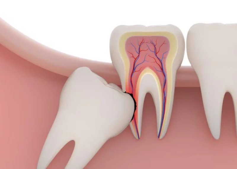 Răng khôn gây ảnh hưởng đến các xương và răng bên cạnh