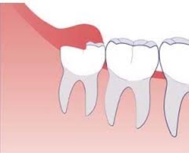 dấu hiệu lợi trùm răng khôn 