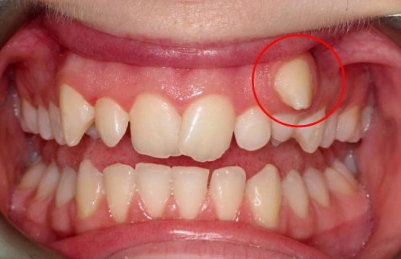 Răng khểnh là gì?  