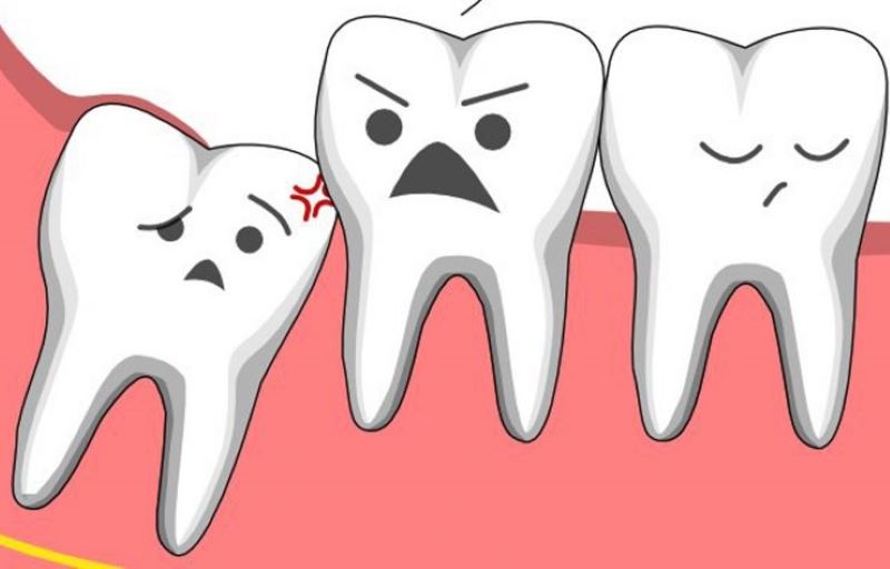 Tại sao nhiều người không mọc răng khôn?