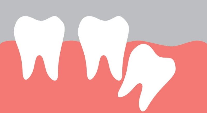 Răng khôn là gì?