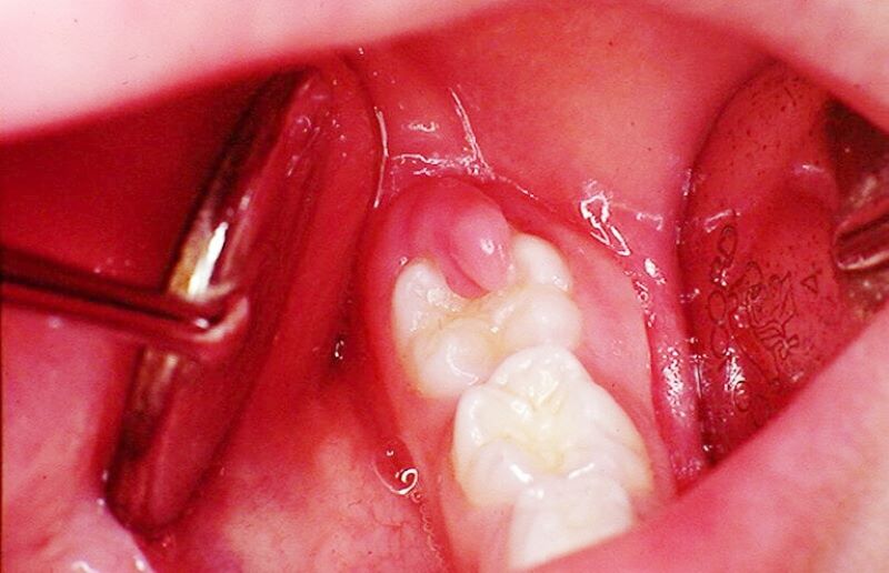 Răng khôn gây viêm nướu