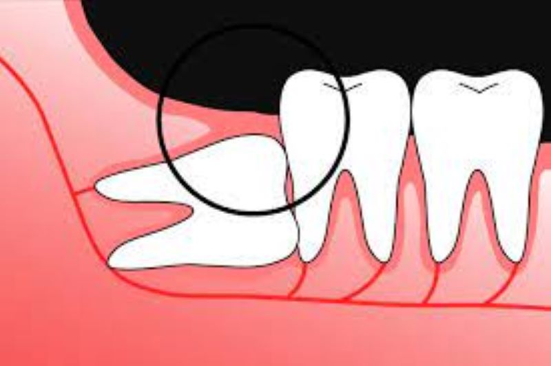 Nhổ răng khôn mọc lệch 90 độ liệu có phải lựa chọn đúng đắn?