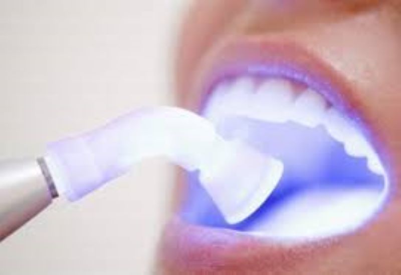 Phương pháp tẩy trắng răng tại phòng khám nha khoa