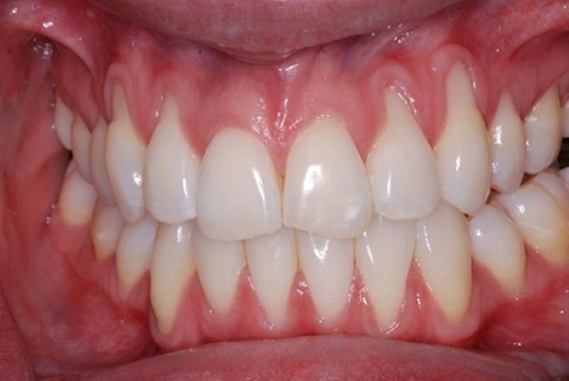 Thế nào là răng bị tụt lợi?