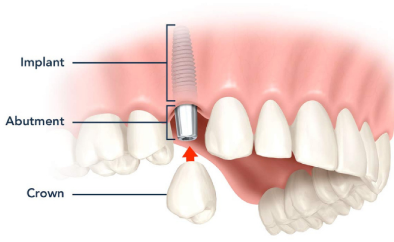 Đối tượng phù hợp trồng răng implant