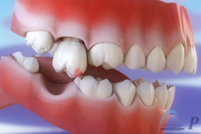 Mất răng ảnh hưởng đến các răng xung quanh