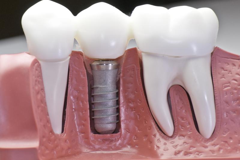 Trồng răng implant diễn ra như thế nào?