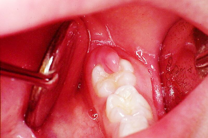 sưng răng viêm nướu