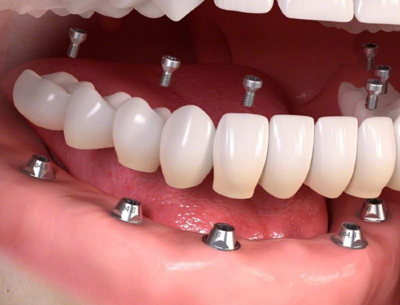 trồng răng implant 1
