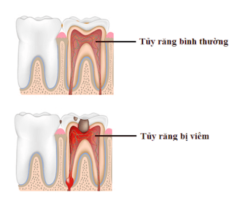 Những răng nào phải điều trị tủy răng 