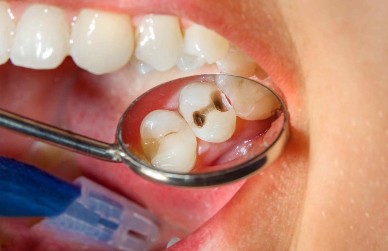 Khi nào thì cần phải điều trị tủy răng?