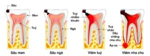 Các giai đoạn phát triển của sâu răng