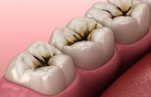 hệ lụy sâu răng