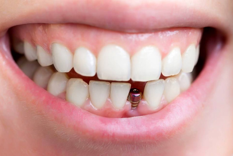 Trồng răng bằng cấy ghép implant là gì?