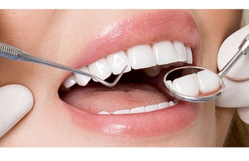 Làm thế nào để duy trì độ bền của răng sứ?
