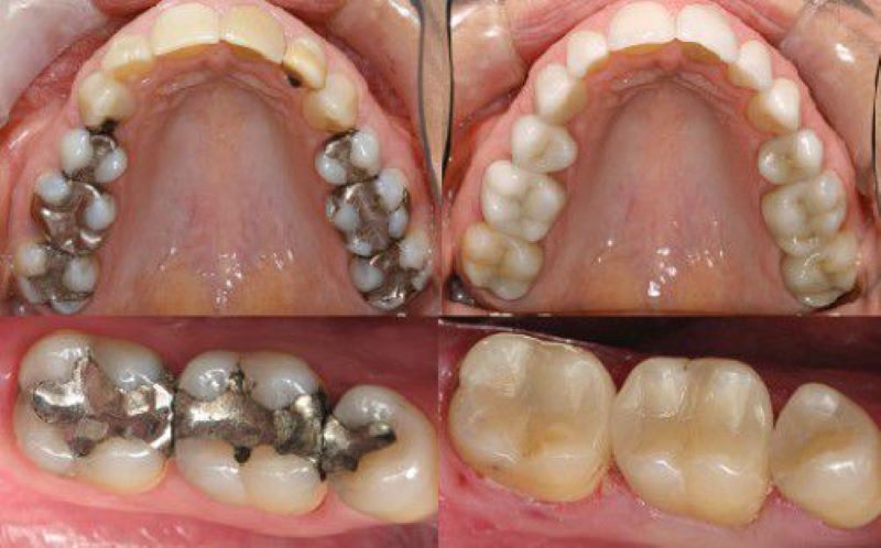 Hậu quả của sâu răng