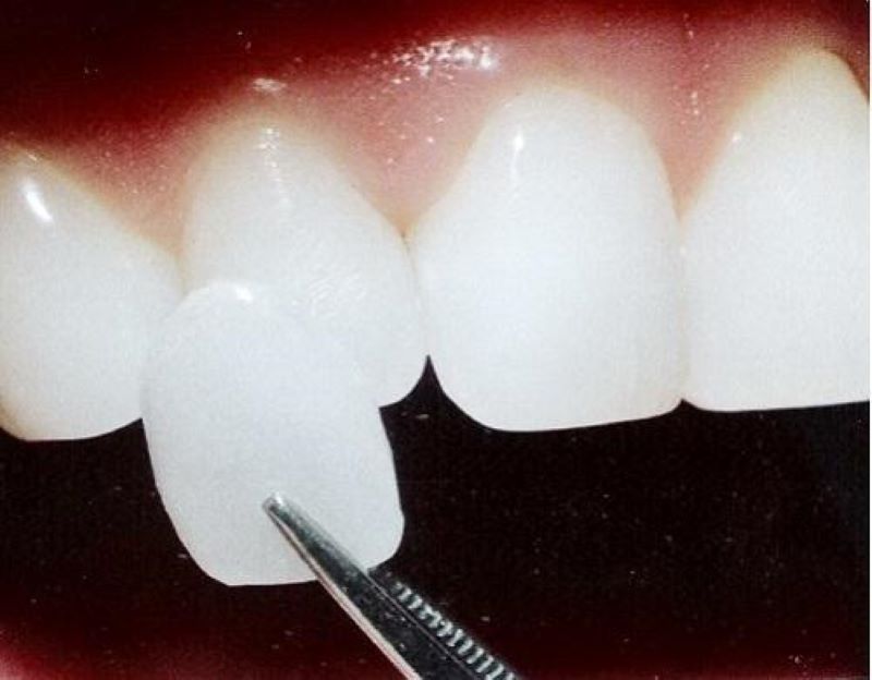 Bọc răng sứ không mài phù hợp với trường hợp nào?