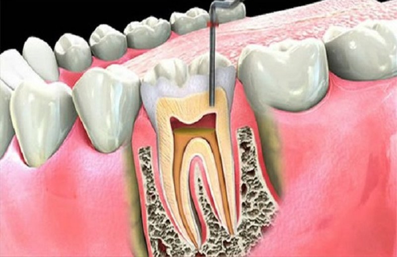 Lấy tủy răng có hại gì không?