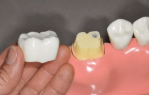 Bọc răng sứ cho răng sâu có được không?