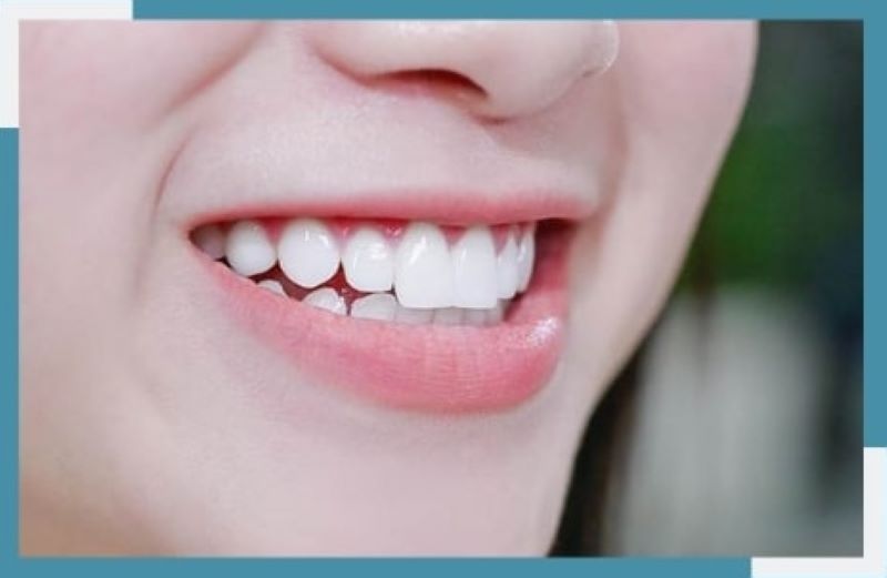 Cân nhắc lựa chọn phương pháp làm răng sứ phù hợp