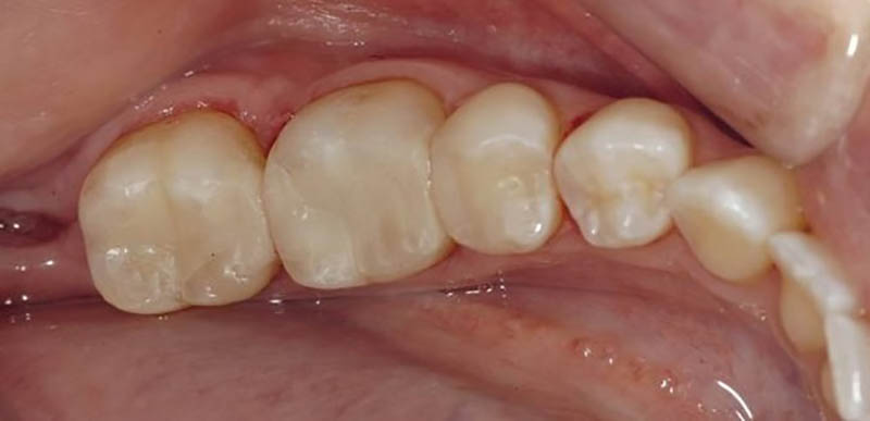 Những dấu hiệu của sâu răng nhẹ