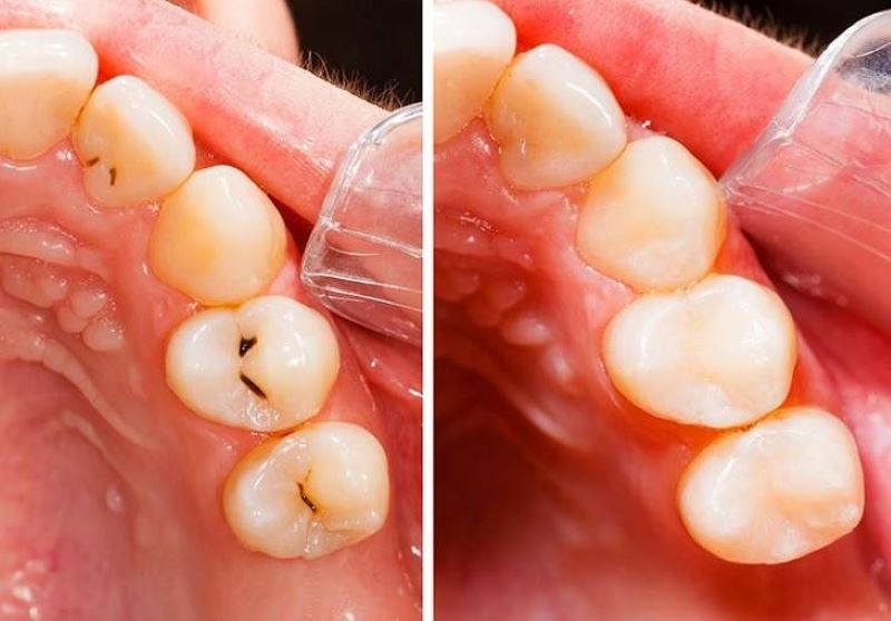 Những dấu hiệu để phát hiện sâu răng