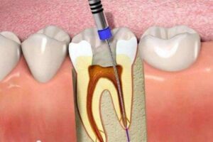 Trám răng lấy tủy là gì?