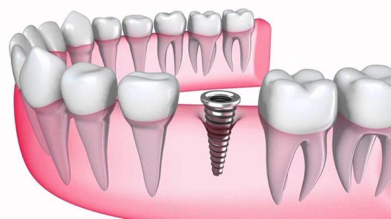 Ưu điểm của trồng răng bằng cấy ghép implant.
