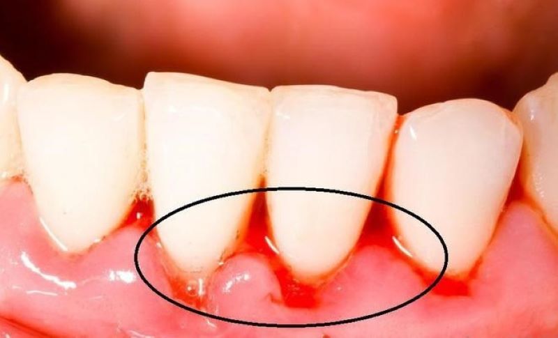 Các cách điều trị viêm lợi chảy máu chân răng?