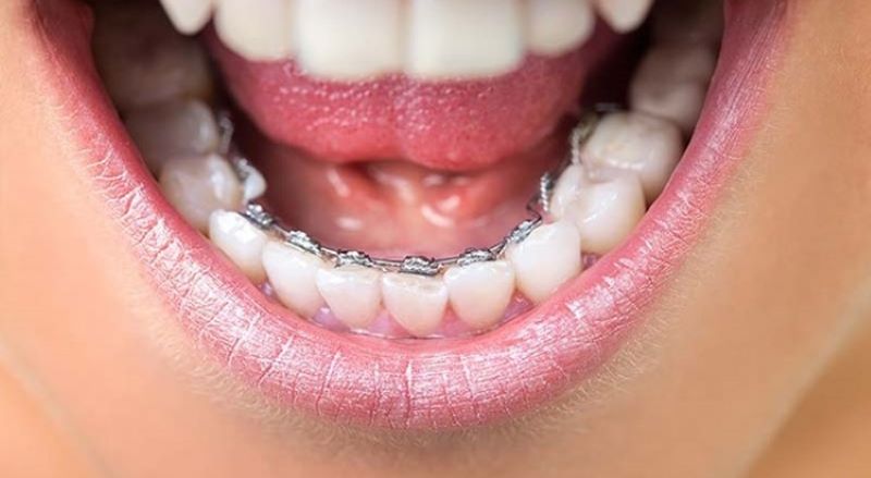 Thời gian niềng răng 1 hàm là bao lâu?