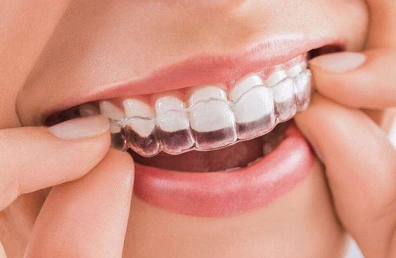 trong suốt Invisalign