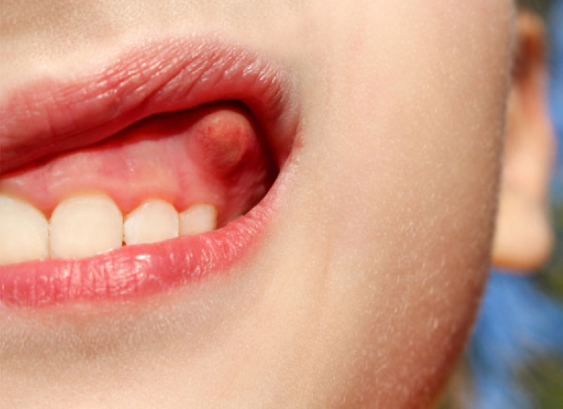 Các nguyên nhân gây ra viêm sưng nướu răng có mủ