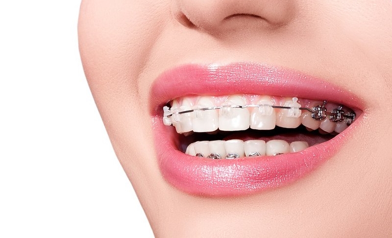 Một số ưu nhược điểm của phương pháp niềng răng