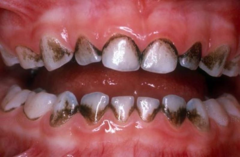 Nguyên nhân gây nên tình trạng cao răng đen