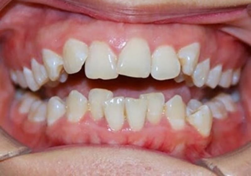 Răng cửa mọc lệch gây ảnh hưởng như thế nào?