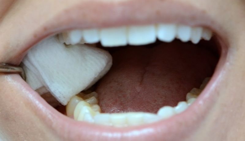 Lưu ý để hạn chế tối đa nhiễm trùng sau khi răng được nhổ