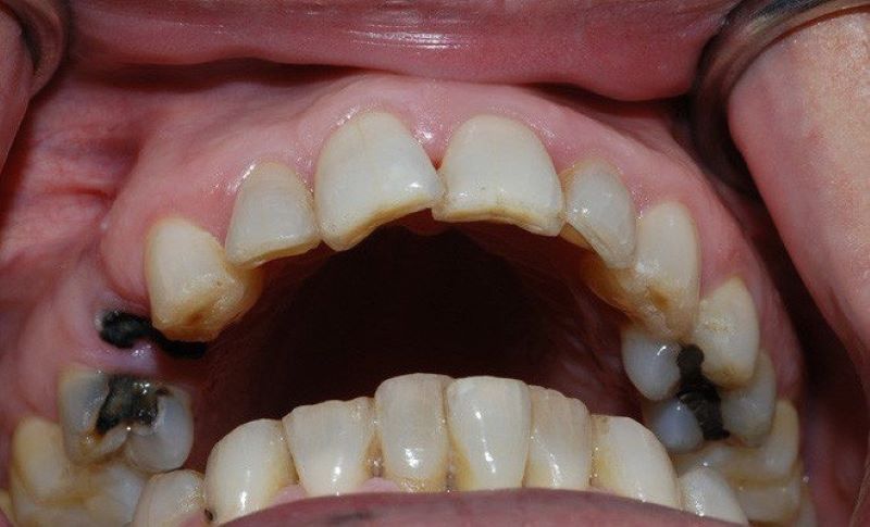 Làm sao để hạn chế tình trạng răng bị sâu đen?