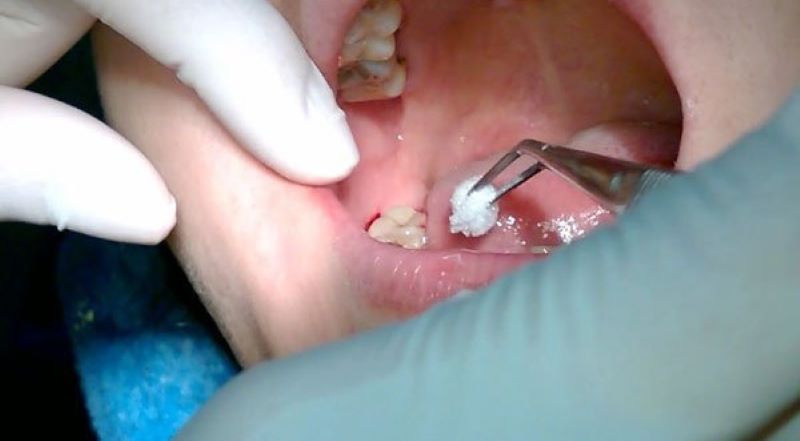 Nhổ răng số 8 có đau không?